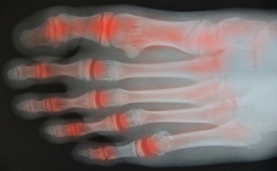 Symptoms of Rheumatoid Arthritis and Osteoarthritis